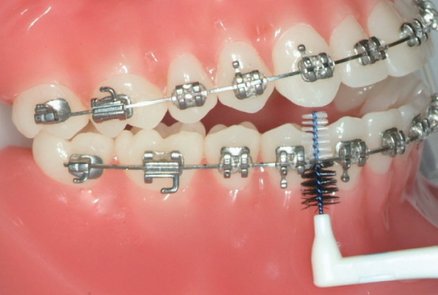 Zähne putzen mit fester Zahnspange - Vorreinigung zwischen allen Brackets mit einem Spezialbürstchen.