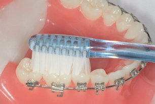 Die Kauflächen der Zähne putzen. Brackets: Pflege bei festsitzenden Zahnspangen