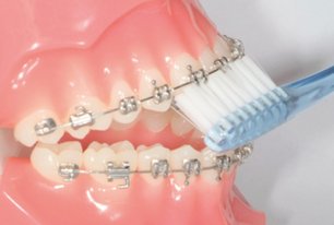 Festsitzender Zahnspange - Oberkiefer - Die Zahnbürste unter dem Drahtbogen