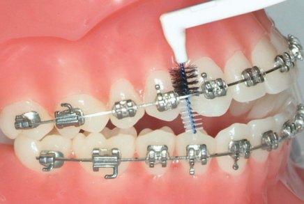 Zahnpflege bei festsitzender Zahnspange