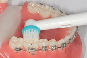 Festsitzender Zahnspange - Zahnfleischsaum und die Zähne von innen putzen.